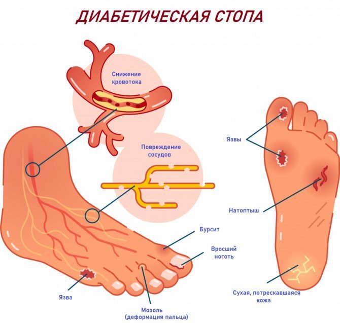 diabeticheskaya-stopa-jpg